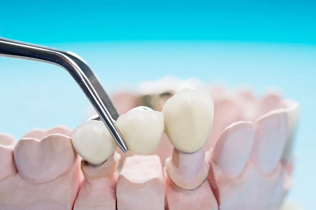 Dental Bridges in Pagosa Springs: A Fixed Solution for Missing Teeth