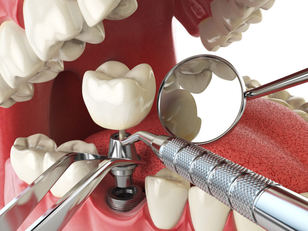Am I a Good Candidate for Dental Implants in Pagosa Springs?